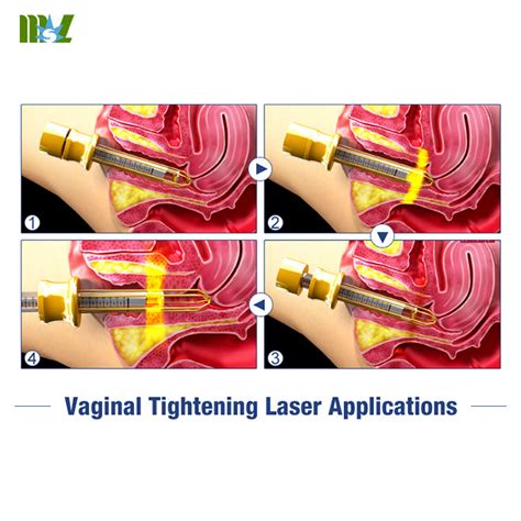 Most Professional Laser Vaginal Tightening Machine MSLCF02