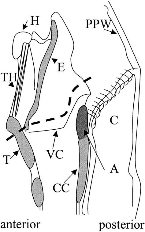Schematic Representation Of Supraglottic Partial Laryngectomy And