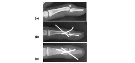 Conservative Treatment Of Chronic Mallet Fracture Non Union After