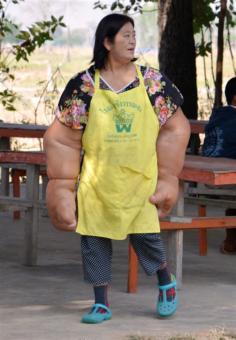 Duangjay Samaksamam la donna thailandese con braccia e mani più grandi