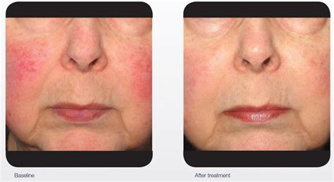 Ipllaser For Redness And Broken Capillaries Qsd