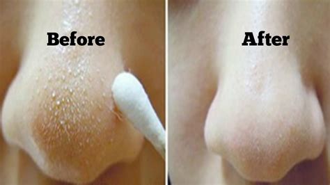 Tips On How Easily To Get Rid Of Blackheads