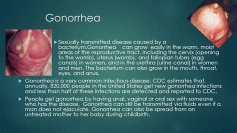 Gonorrhea Symptoms Pictures Men Hacjourney