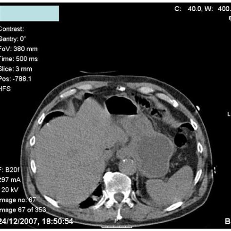 Ct Scan Of The Abdomen Showing Air Fluid Level In The Small Bowel