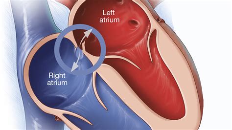 Le Foramen Ovale Avgplongee