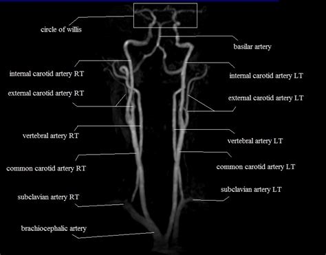 Carotid arteries in neck head and face carotid arteries olfactory bulb cranial nerves. neck arteries | MRA neck arteries anatomy