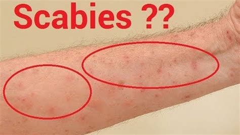 How To Know If You Have Scabies And Natural Treatments That Work Fast Youtube