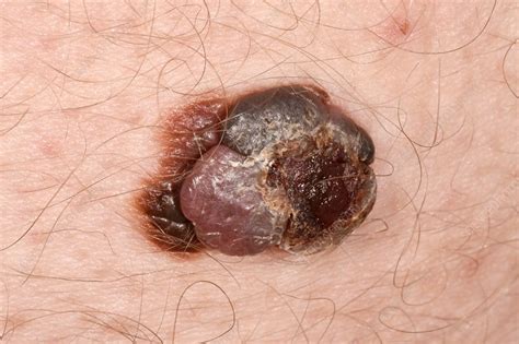 Peng, who also is a dermatologist at keck medicine of usc. Malignant melanoma skin cancer - Stock Image - C037/0929 ...