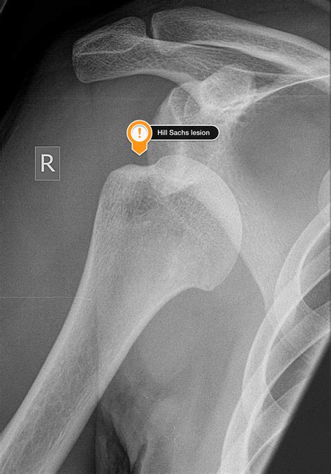 Fracture Fridays Bony Complications Of Repeated Shoulder Dislocations