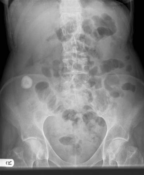 X Ray Of The Abdomen Showing Calcification In Right Iliac Fossa