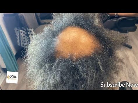 How To Fix Damaged Hair Severe Alopecia Not Fixable But See The Transformation Youtube