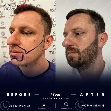Beard Facial Transplantation In Istanbul Hairneva Clinic