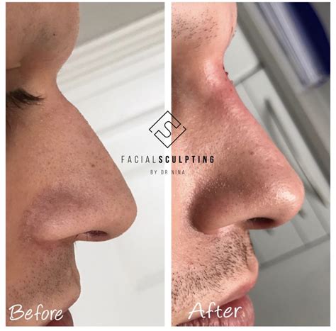 dorsal hump nose correction facial sculpting