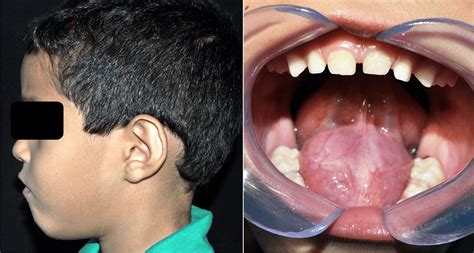 Extraoral Examination Showing Volume Increase In The Submental Region