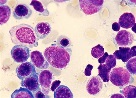 Algunas leucemias, con frecuencia, puede curarse. LEUCEMIA PROMIELOCITICA AGUDA PDF