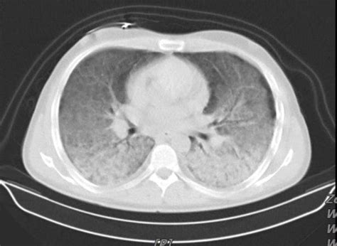 Ct Scan Of The Chest Showed Bilateral Alveolar Infiltration With Air