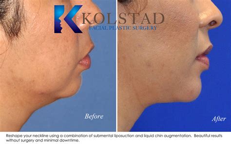 Non Surgical Chin Augmentation And Submental Liposuction Before And After