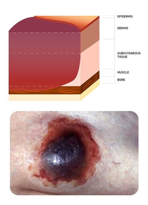 Wound Types Pressure Injuries And Ulcerations Images And Photos Finder
