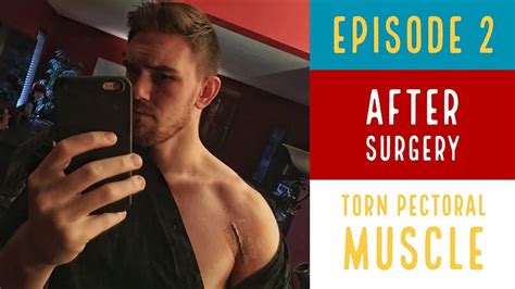 After Surgery Torn Pectoral Muscle Episode 2 Youtube