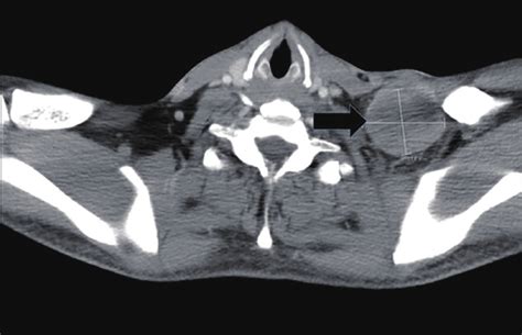 Ct Image Depicting Left Supraclavicular Lymphadenopathy Mass