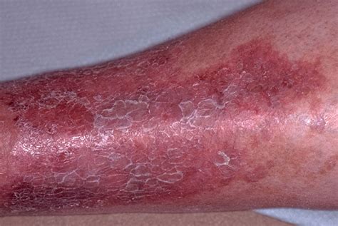Lower Leg Eczema Differential Diagnosis Gponline