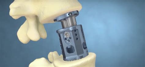 K2ms 3d Printed Capri Spinal Implant Gains Ce With First Operation