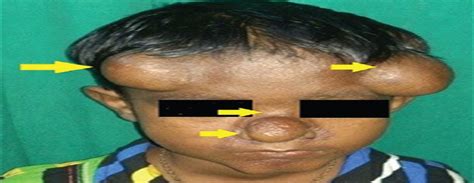 Juvenile Hyaline Fibromatosis A Rare Genetic Disorder Indian Journal
