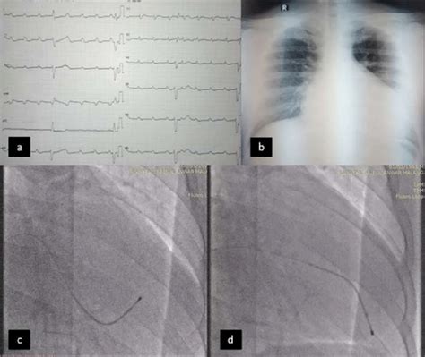 A Ecg Shows Total Av Block B Chest X Ray Shows Cardiomegaly C