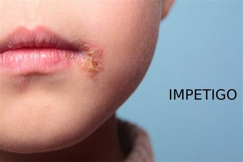 Impetigo Causes Symptoms Treatment Impetigo