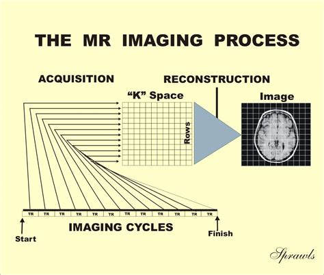 So image processing is the subset of computer vision. Magnetic Resonance Imaging