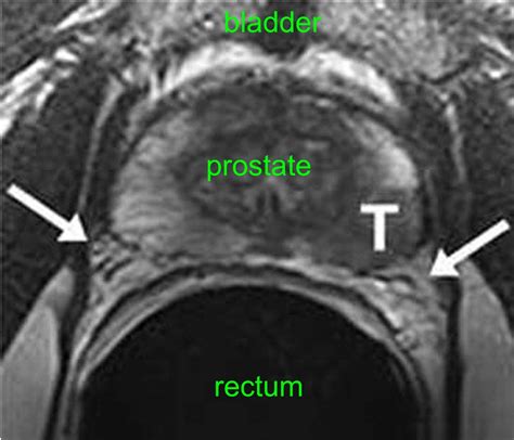 Prostate Mri Scan Showing Cancer Hot Sex Picture