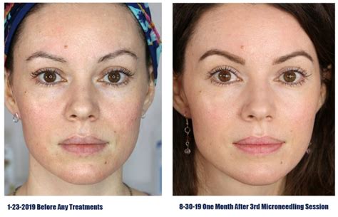 before and after 3 microneedling treatments with the dr pen shocking