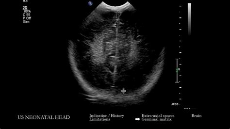Us Neonatal Head Ultrasound Search Pattern Youtube