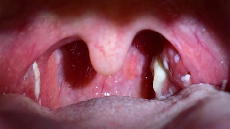 Pharyngeal Tonsils Location