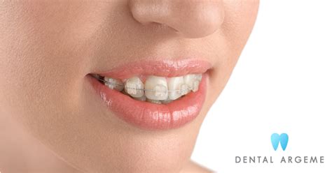 Ortodoncia Con Brackets Clinica Dental Argeme