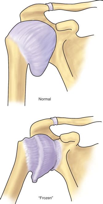 Adhesive Capsulitis Frozen Shoulder Musculoskeletal Key