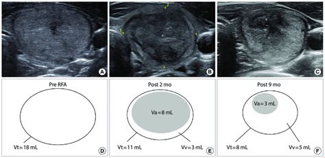 Ultrasonography Of A Thyroid Nodule A Pre Radiofrequency Ablation