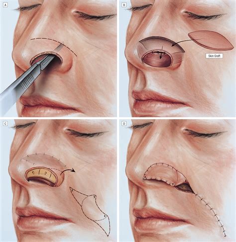 Reconstruction Of Nasal Alar Defects Jama Facial Plastic Surgery Free