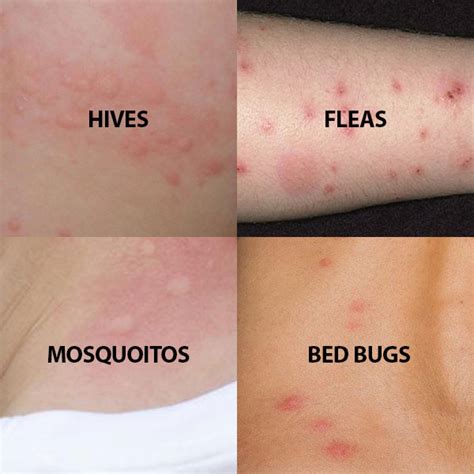 Bed Bug Bites Can Cause Hives Bedbugs
