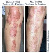 Photos of Is There A Treatment For Psoriasis