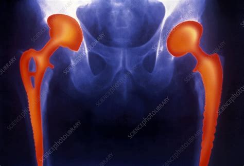 Coloured X Ray Of Two Prosthetic Hip Joints Stock Image M6000118