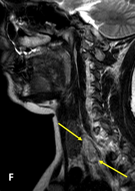Parathyroid Adenoma Diagnosis Mri Online