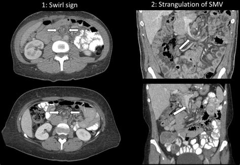 Illustrative Ct Findings In The Diagnosis Of Internal Hernia After