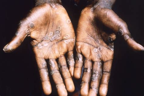 Monkeypox How It Spreads Whos At Risk Heres What You Need To Know
