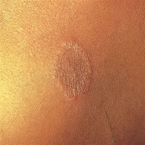 Tinea Versicolor Diseases And Conditions 5minuteconsult
