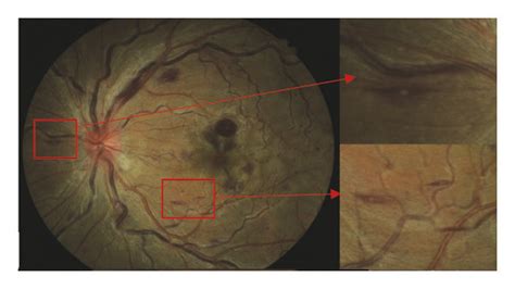 Fundus Abnormalities At Presentation A Swelling Optic Disc With