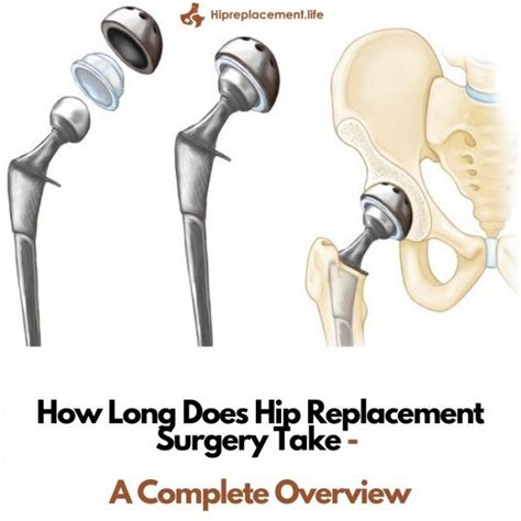 How Long Does Hip Replacement Surgery Take A Complete Overview