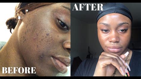 How To Clear Dark Spots Hyperpigmentation And Uneven Skin Tone Asap