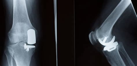 Partial Knee Arthroplasty Dr Michael Serhal