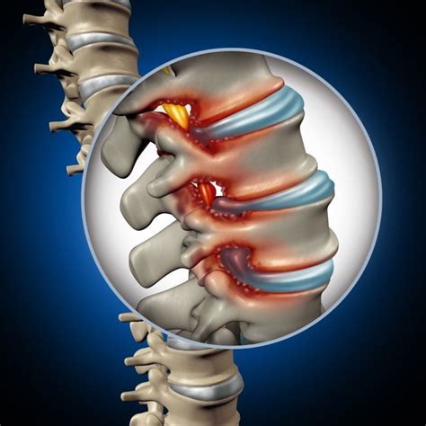 10 Symptoms of Spinal Stenosis - Facty Health | Spinal decompression, Stenosis, Spinal stenosis